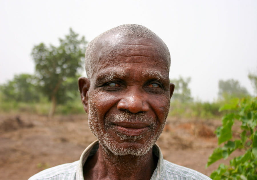 Blindness is a global issue.