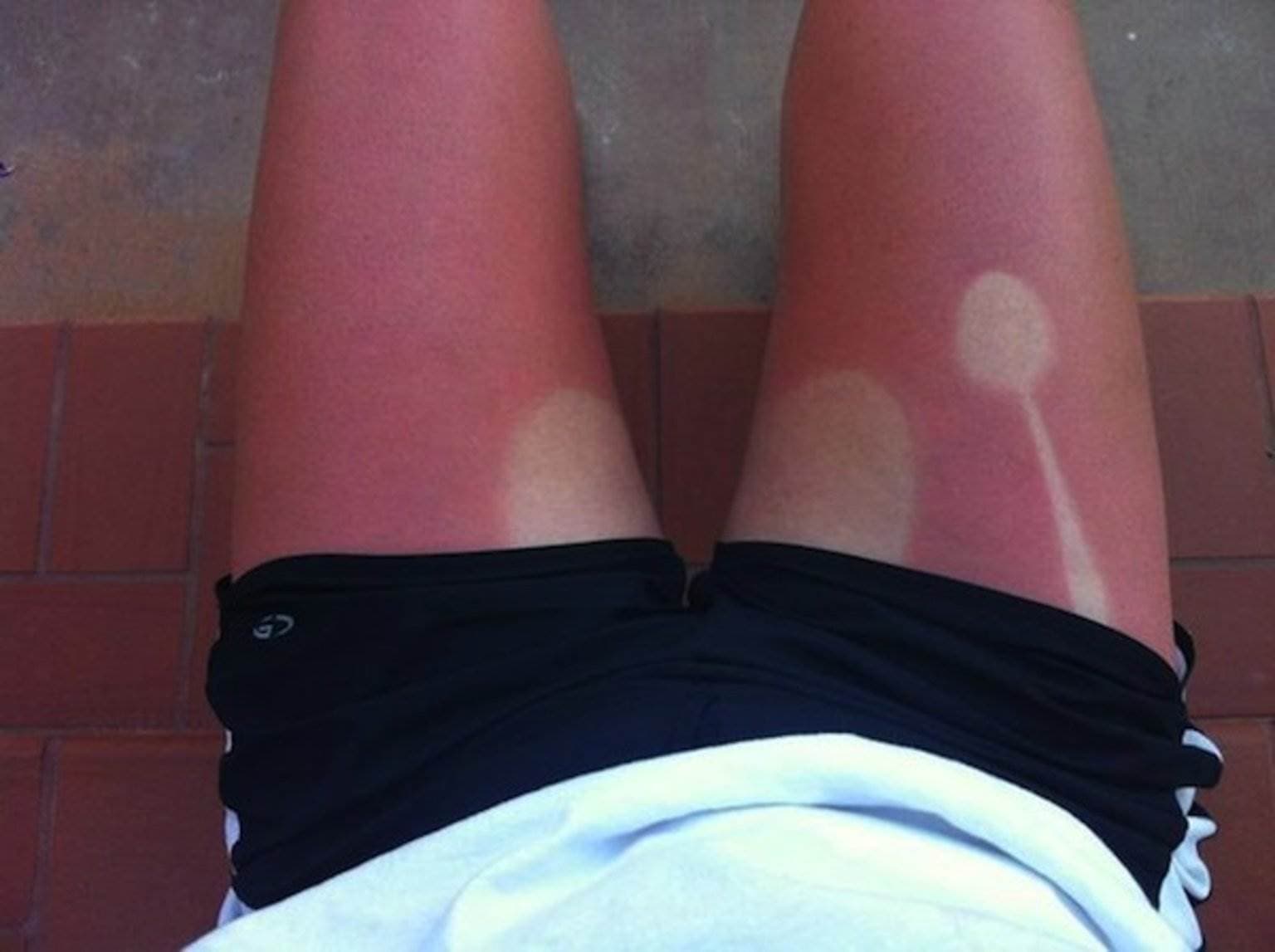 Sunburn-Treatment